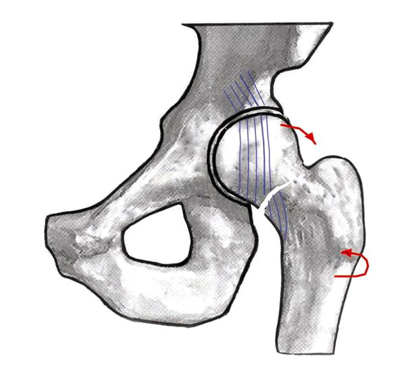 Femoral neck fractures